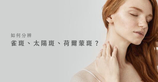 如何分辨雀斑、太陽斑、荷爾蒙斑?